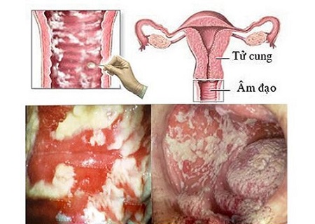 Nấm vùng kín là dấu hiệu của nhiều bệnh nguy hiểm
