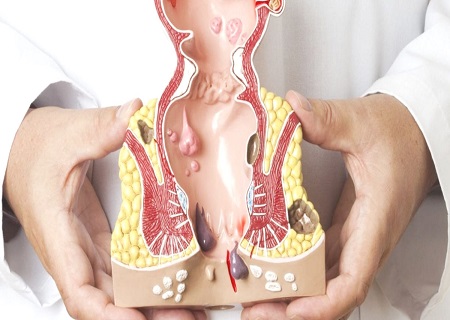 điều trị bệnh trĩ hiệu quả tại phòng khám Kinh Đô