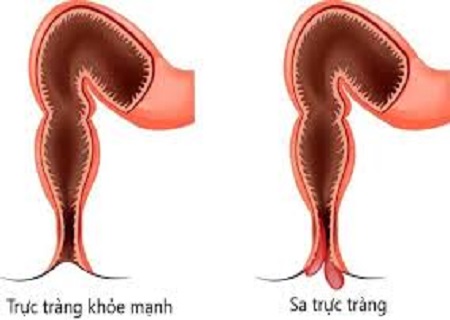 Điều trị sa trực tràng bằng phương pháp hiện đại