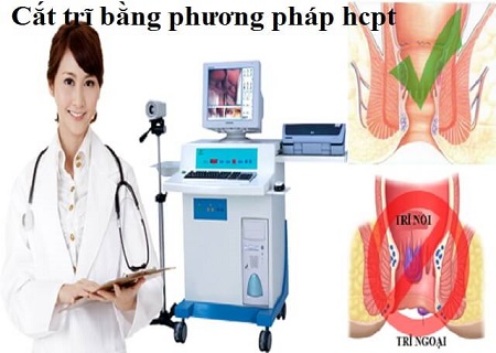 điều trị trĩ ngoại bằng phương pháp HCPT hiện đại
