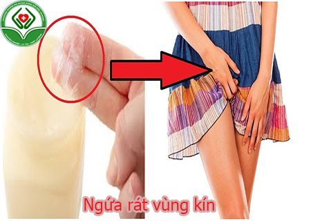 ngứa rát vùng kín