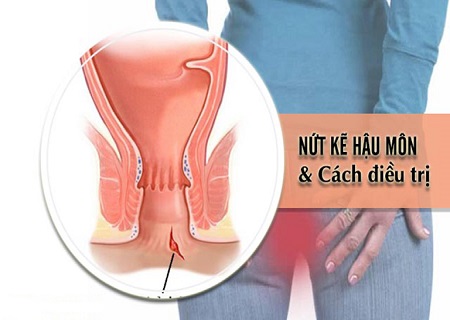 nứt kẽ hậu môn gây đau đớn cho người bệnh