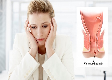 nứt kẽ hậu môn khiến người bệnh vô cùng lo lắng