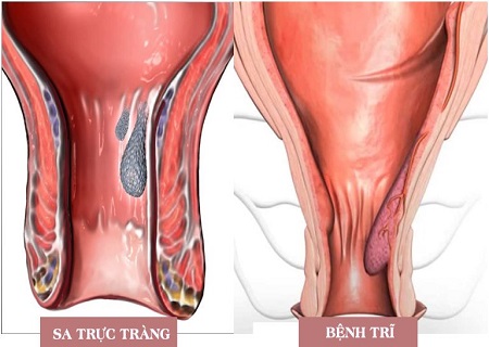 Sa trực tràng ảnh hưởng lớn tới sức khỏe người bệnh