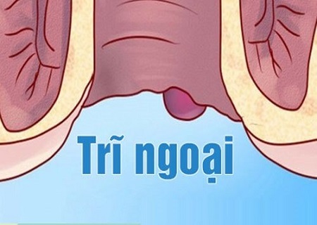 trĩ ngoại là căn bệnh khá phổ biến