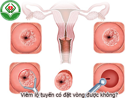 Viêm lộ tuyến có đặt vòng được không?