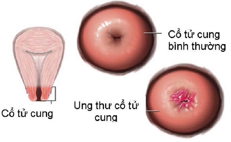 viêm lộ tuyến gây ảnh hưởng nhiều tới sức khỏe của các chị em 