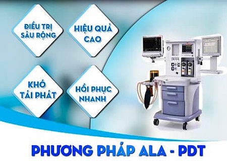 Phương pháp ALA-PDT chữa sùi mào gà hiệu quả