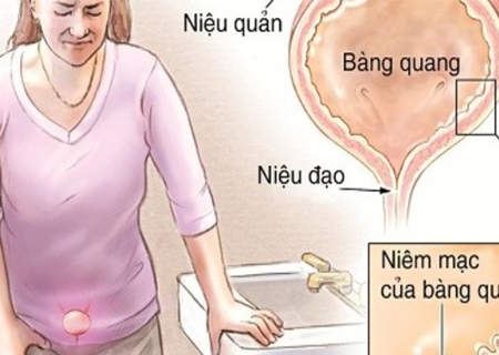 Viêm đường tiết niệu nữ là căn bệnh nguy hiểm