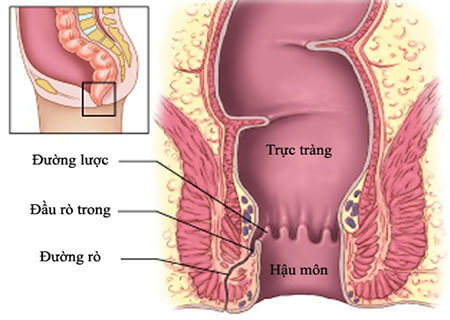 Đôi nét về bệnh mạch lươn