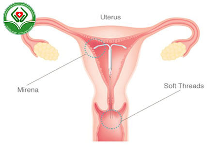Hình ảnh vòng tránh thai khi đặt vào tử cung