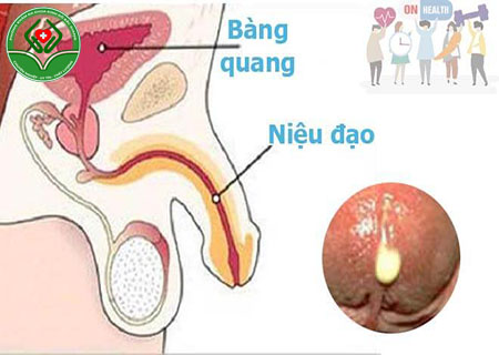 Viêm đường tiết niệu chảy mủ chớ chủ quan