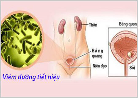 Tìm hiểu bệnh viêm tiết niệu mãn tính