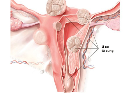 U xơ tử cung là căn bệnh thường gặp ở nữ giới