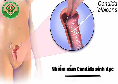 Bệnh nấm Candida ở nữ giới rất phổ biến