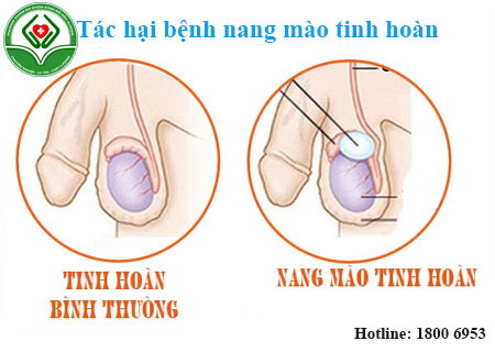 Nang mào tinh hoàn gây nhiều biến chứng