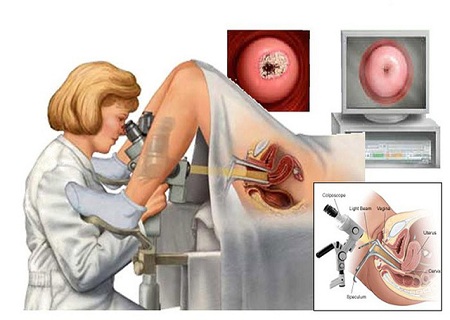 Nội soi âm đạo, cổ tử cung phát hiện sớm các bệnh lý nguy hiểm