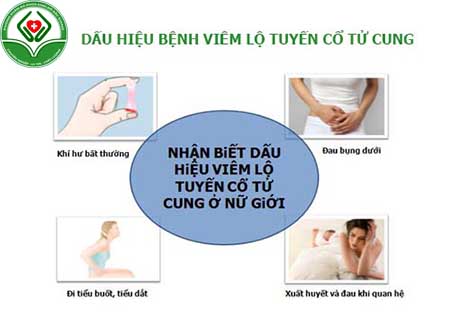 dấu hiệu của bệnh viêm lộ tuyến cổ tử cung