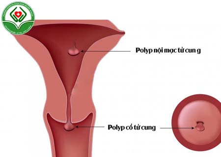 Bệnh polyp tử cung là gì