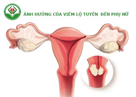 ảnh hưởng của viêm lộ tuyến cổ tử cung đến phụ nữ