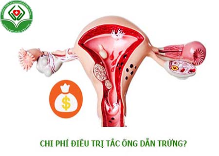 chi phí điều trị tắc ống dẫn trứng