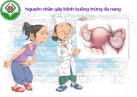 Nguyên nhân gây bệnh buồng trứng đa nang