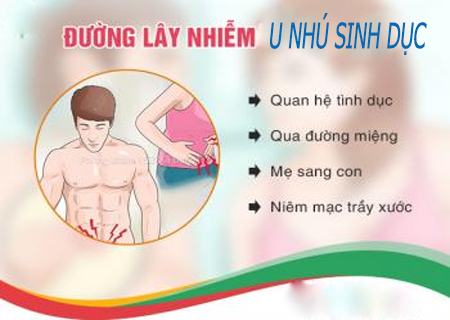 U nhú sinh dục lây qua nhiều con đường khác nhau