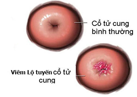 bieu-hien-cua-viem-lo-tuyen-co-tu-cung