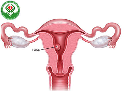 Polyp cổ tử cung ác tính là gì