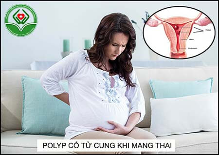 polyp cổ tử cung ảnh hưởng như thế nào đến khả năng mang thai