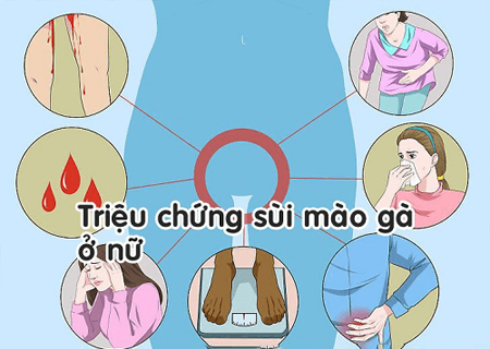 Sùi mào gà ở nữ có các dấu hiệu cụ thể