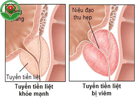 bệnh viêm tiền liệt tuyến là gì