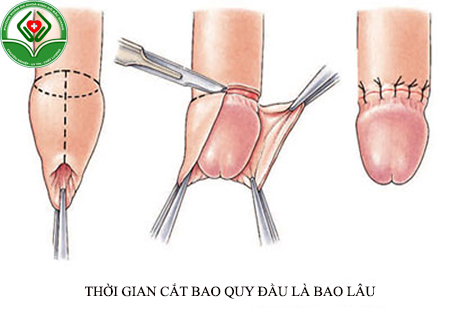 Thời gian cắt bao quy đầu là bao lâu