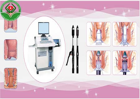 HCPT là phương pháp gì