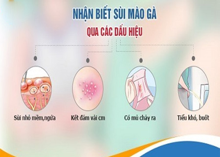 Sùi mào gà có thể nhận biết thông qua nhiều dấu hiệu cụ thể