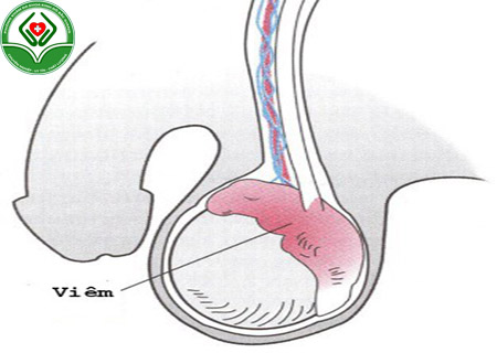 biểu hiện viêm mào tinh hoàn