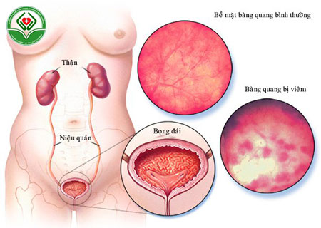 dieu-tri-viem-bang-quang-chay-mau