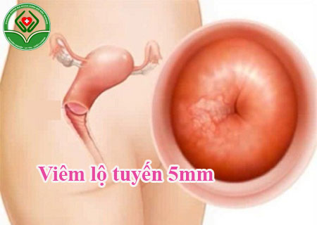 Viêm lộ tuyến 5mm