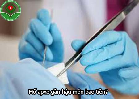 Mổ apxe gần hậu môn bao tiền?