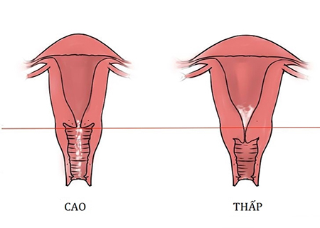 Cổ tử cung cao ảnh tới khả năng sinh sản