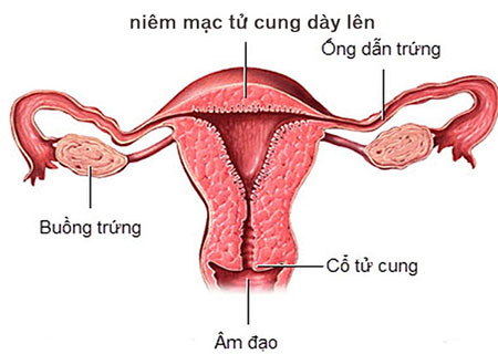 Niêm mạc tử cung dày do nhiều nguyên nhân