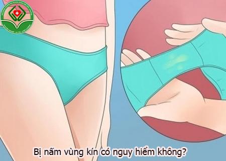 nấm vùng kín có nguy hiểm không?