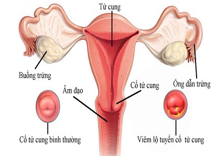 viêm lộ tuyến cổ tử cung là căn bệnh nguy hiểm