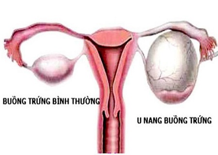 U nang buồng trứng là căn bệnh nguy hiểm