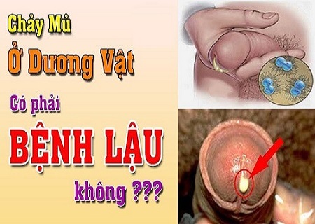 Dương vật bị ngứa và chảy mủ là dấu hiệu của bệnh lậu