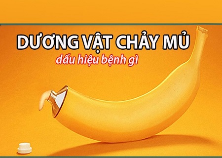 Dương vật bị sưng và chảy mủ là dấu hiệu của bệnh viêm niệu đạo