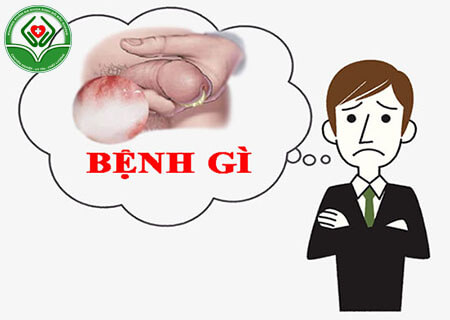 Chảy mủ dương vật vào buổi sáng là bệnh gì?