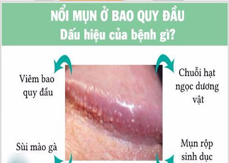 Nổi mụn rãnh quy đầu là dấu hiệu của nhiều bệnh nguy hiểm ãnh quy đầu là dấu hiệu của nhiều bệnh nguy hiểm