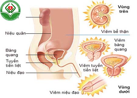 Bị viêm đường tiết niệu ở nam