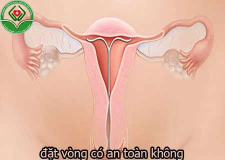 đặt vòng có an toàn không